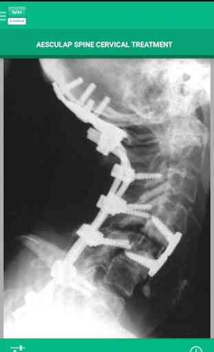 AESCULAP Spine Cervical 4