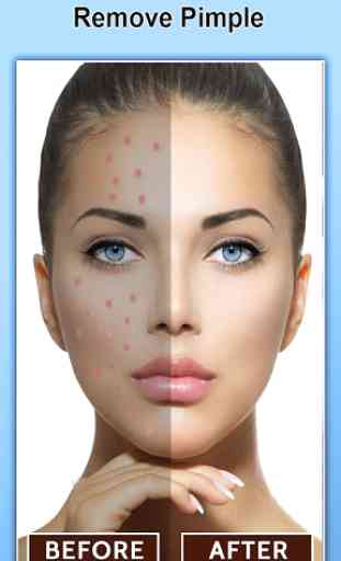 Pimple & Acne Remove 2019 1